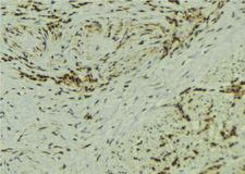 SS18L1 / CREST Antibody - 1:100 staining human breast carcinoma tissue by IHC-P. The sample was formaldehyde fixed and a heat mediated antigen retrieval step in citrate buffer was performed. The sample was then blocked and incubated with the antibody for 1.5 hours at 22°C. An HRP conjugated goat anti-rabbit antibody was used as the secondary.