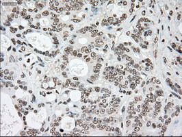 SSB / La Antibody - IHC of paraffin-embedded Adenocarcinoma of colon tissue using anti-SSB mouse monoclonal antibody. (Dilution 1:50).