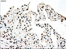 SSB / La Antibody - IHC of paraffin-embedded Carcinoma of lung tissue using anti-SSB mouse monoclonal antibody. (Dilution 1:50).