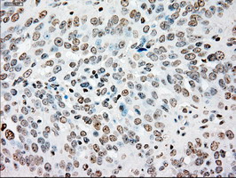 SSB / La Antibody - IHC of paraffin-embedded Adenocarcinoma of ovary tissue using anti-SSB mouse monoclonal antibody. (Dilution 1:50).