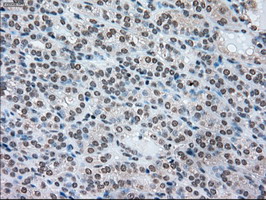 SSB / La Antibody - IHC of paraffin-embedded Carcinoma of thyroid tissue using anti-SSB mouse monoclonal antibody. (Dilution 1:50).