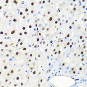 SSB / La Antibody - Immunohistochemistry of paraffin-embedded human liver cancer using SSB antibodyat dilution of 1:100 (40x lens).