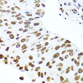 SSB / La Antibody - Immunohistochemistry of paraffin-embedded human prostate cancer using SSB antibodyat dilution of 1:100 (40x lens).