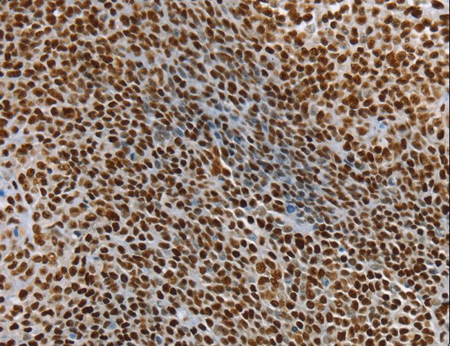 SSB / La Antibody - Immunohistochemistry of paraffin-embedded Human ovarian cancer using SSB Polyclonal Antibody at dilution of 1:25.