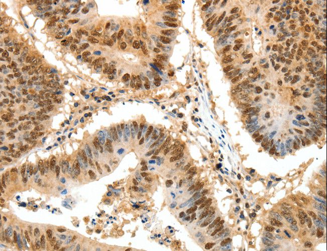 SSB / La Antibody - Immunohistochemistry of paraffin-embedded Human ovarian cancer using SSB Polyclonal Antibody at dilution of 1:50.