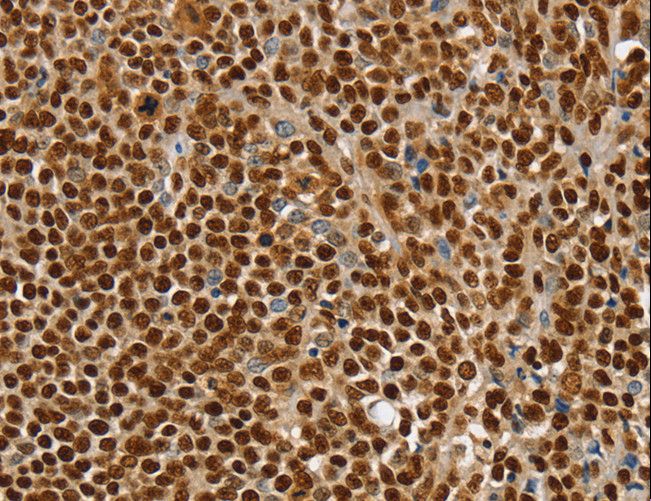 SSB / La Antibody - Immunohistochemistry of paraffin-embedded Human ovarian cancer using SSB Polyclonal Antibody at dilution of 1:30.