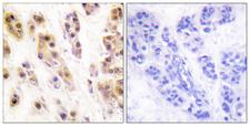 SSB / La Antibody - Immunohistochemistry analysis of paraffin-embedded human breast carcinoma, using SSB (Phospho-Ser366) Antibody. The picture on the right is blocked with the phospho peptide.