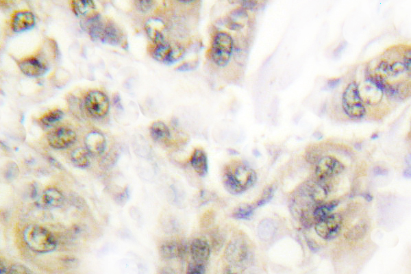 SSB / La Antibody - IHC of PR (A394) pAb in paraffin-embedded human breast carcinoma tissue.
