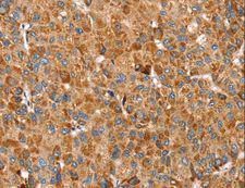 SSBP1 / mtSSB Antibody - Immunohistochemistry of paraffin-embedded Human liver cancer using SSBP1 Polyclonal Antibody at dilution of 1:30.