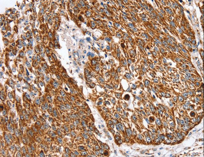 SSBP1 / mtSSB Antibody - Immunohistochemistry of paraffin-embedded Human lung cancer using SSBP1 Polyclonal Antibody at dilution of 1:30.