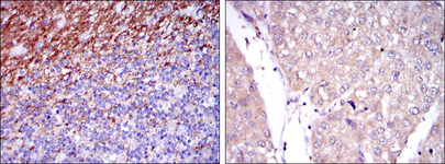 SSEA-1 / Lewis x / CD15 Antibody - IHC of paraffin-embedded human cerebellum tissues (left) and human liver cancer tissues (right) using CD15 mouse monoclonal antibody with DAB staining.