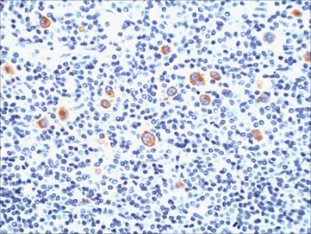 SSEA-1 / Lewis x / CD15 Antibody - Formalin-fixed, paraffin-embedded human Hodgkin's lymphoma stained with SSEA-1 antibody (SPM490).  This image was taken for the unmodified form of this product. Other forms have not been tested.