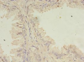 SSFA2 Antibody - Immunohistochemistry of paraffin-embedded human prostate cancer using antibody at 1:100 dilution.  This image was taken for the unconjugated form of this product. Other forms have not been tested.