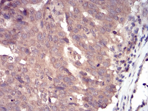 SSH1 Antibody - Immunohistochemical analysis of paraffin-embedded ovarian cancer tissues using SLINGSHOT-1L mouse mAb with DAB staining.