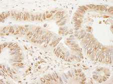 SSH3 Antibody - Detection of Human SSH3 by Immunohistochemistry. Sample: FFPE section of human colon carcinoma. Antibody: Affinity purified rabbit anti-SSH3 used at a dilution of 1:200 (1 ug/ml). Detection: DAB.