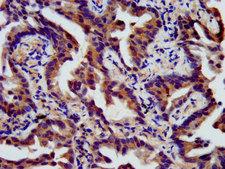 SSH3 Antibody - Immunohistochemistry image at a dilution of 1:400 and staining in paraffin-embedded human lung cancer performed on a Leica BondTM system.