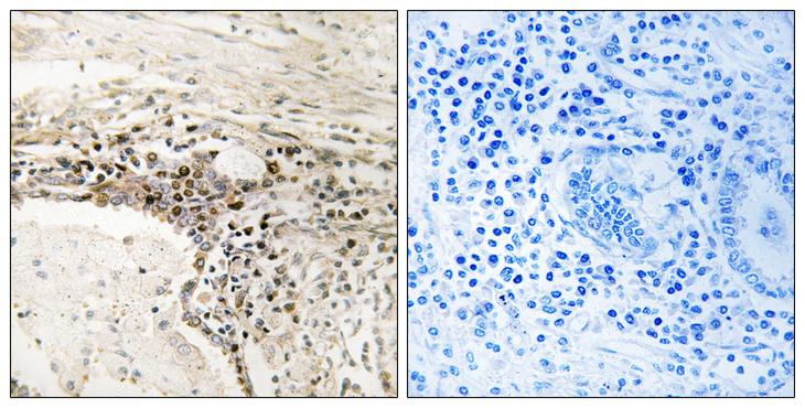 SSH3 Antibody - Peptide - + Immunohistochemistry analysis of paraffin-embedded human lung carcinoma tissue using SSH3 antibody.