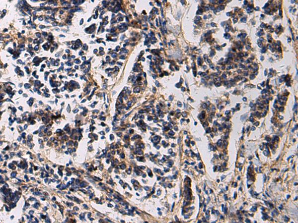 SSH3 Antibody - Immunohistochemistry of paraffin-embedded Human breast cancer tissue  using SSH3 Polyclonal Antibody at dilution of 1:60(×200)