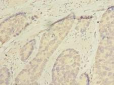 SSMEM1 / C7orf45 Antibody - Immunohistochemistry of paraffin-embedded human gastric cancer using antibody at dilution of 1:100.