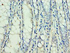 SSNA1 Antibody - Immunohistochemistry of paraffin-embedded human colon cancer using antibody at 1:100 dilution.
