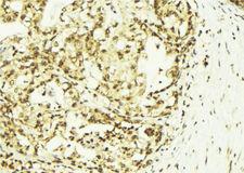 SSNA1 Antibody - 1:100 staining human breast carcinoma tissue by IHC-P. The sample was formaldehyde fixed and a heat mediated antigen retrieval step in citrate buffer was performed. The sample was then blocked and incubated with the antibody for 1.5 hours at 22°C. An HRP conjugated goat anti-rabbit antibody was used as the secondary.