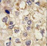 SSR1 Antibody - Formalin-fixed and paraffin-embedded human hepatocarcinoma tissue reacted with SSR1 antibody , which was peroxidase-conjugated to the secondary antibody, followed by DAB staining. This data demonstrates the use of this antibody for immunohistochemistry; clinical relevance has not been evaluated.