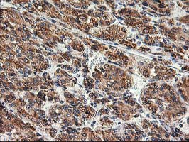 SSR1 Antibody - IHC of paraffin-embedded Carcinoma of Human liver tissue using anti-SSR1 mouse monoclonal antibody.