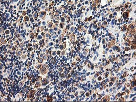 SSR1 Antibody - IHC of paraffin-embedded Carcinoma of Human lung tissue using anti-SSR1 mouse monoclonal antibody.