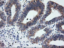 SSR1 Antibody - IHC of paraffin-embedded Adenocarcinoma of Human endometrium tissue using anti-SSR1 mouse monoclonal antibody.