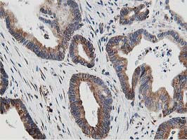 SSR1 Antibody - IHC of paraffin-embedded Adenocarcinoma of Human colon tissue using anti-SSR1 mouse monoclonal antibody.