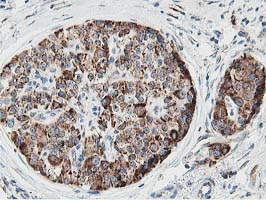 SSR1 Antibody - IHC of paraffin-embedded Carcinoma of Human pancreas tissue using anti-SSR1 mouse monoclonal antibody.