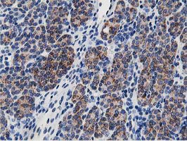 SSR1 Antibody - IHC of paraffin-embedded Carcinoma of Human thyroid tissue using anti-SSR1 mouse monoclonal antibody.