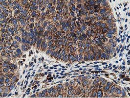 SSR1 Antibody - IHC of paraffin-embedded Carcinoma of Human bladder tissue using anti-SSR1 mouse monoclonal antibody.