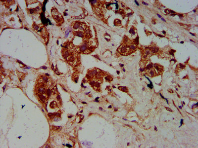 SSR2 Antibody - Immunohistochemistry Dilution at 1:500 and staining in paraffin-embedded human breast cancer performed on a Leica BondTM system. After dewaxing and hydration, antigen retrieval was mediated by high pressure in a citrate buffer (pH 6.0). Section was blocked with 10% normal Goat serum 30min at RT. Then primary antibody (1% BSA) was incubated at 4°C overnight. The primary is detected by a biotinylated Secondary antibody and visualized using an HRP conjugated SP system.