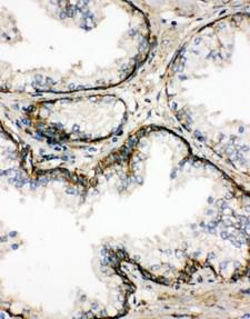 SSR3 / TRAP-Gamma Antibody - SSR3 / TRAP-Gamma antibody. IHC(P): Human Prostatic Cancer Tissue.