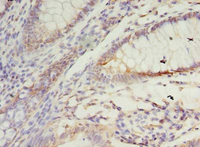 SSR3 / TRAP-Gamma Antibody - Immunohistochemistry of paraffin-embedded human colon cancer using antibody at dilution of 1:100.