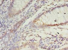 SSR3 / TRAP-Gamma Antibody - Immunohistochemistry of paraffin-embedded human colon cancer using antibody at dilution of 1:100.