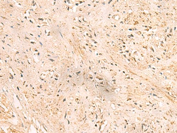 SSSCA1 / p27 Antibody - Immunohistochemistry of paraffin-embedded Human prost ate cancer tissue  using SSSCA1 Polyclonal Antibody at dilution of 1:50(×200)