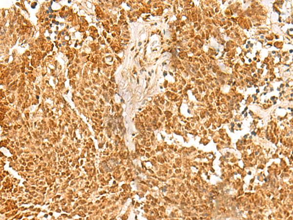 SSSCA1 / p27 Antibody - Immunohistochemistry of paraffin-embedded Human lung cancer tissue  using SSSCA1 Polyclonal Antibody at dilution of 1:50(×200)