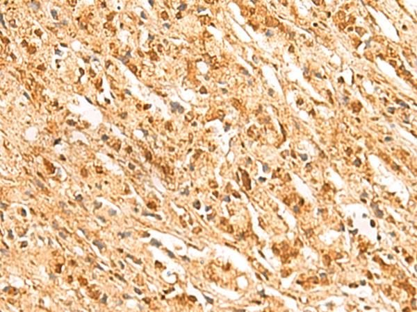 SSSCA1 / p27 Antibody - Immunohistochemistry of paraffin-embedded Human prost ate cancer tissue  using SSSCA1 Polyclonal Antibody at dilution of 1:50(×200)