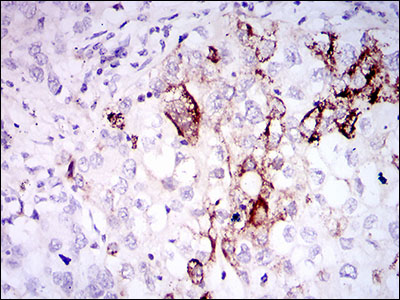 SST / Somatostatin Antibody - IHC of paraffin-embedded lung cancer tissues using SST mouse monoclonal antibody with DAB staining.