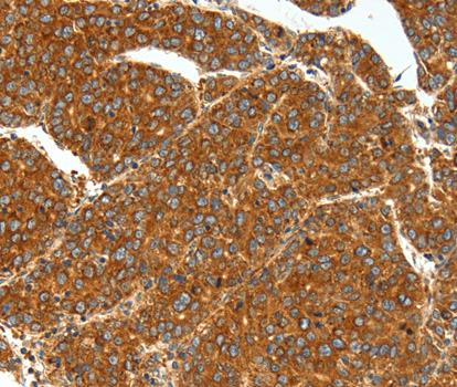 SSTR1 Antibody - Immunohistochemistry of paraffin-embedded human liver cancer tissue.