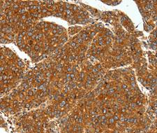 SSTR1 Antibody - Immunohistochemistry of paraffin-embedded human liver cancer tissue.