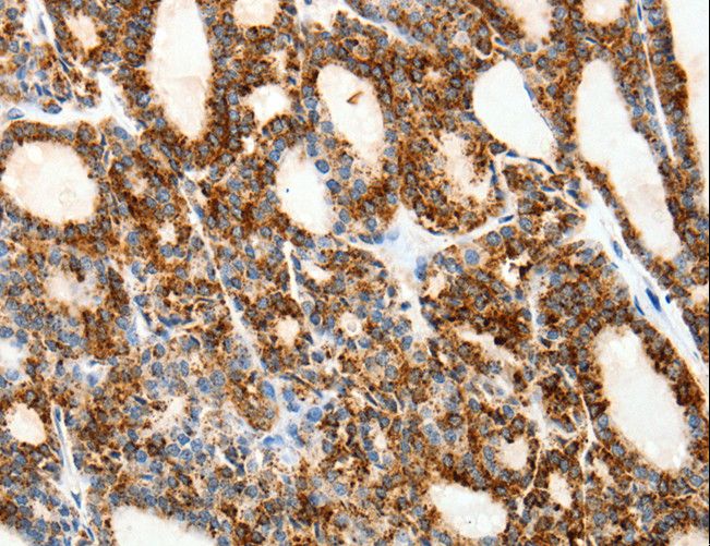 SSTR1 Antibody - Immunohistochemistry of paraffin-embedded Human thyroid cancer using SSTR1 Polyclonal Antibody at dilution of 1:50.