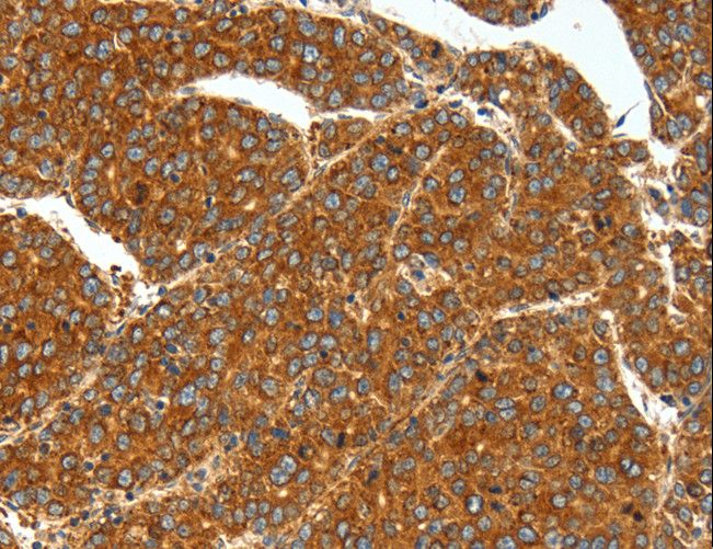 SSTR1 Antibody - Immunohistochemistry of paraffin-embedded Human liver cancer using SSTR1 Polyclonal Antibody at dilution of 1:40.