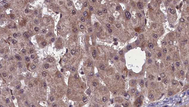 SSTR2 Antibody - 1:100 staining human liver carcinoma tissues by IHC-P. The sample was formaldehyde fixed and a heat mediated antigen retrieval step in citrate buffer was performed. The sample was then blocked and incubated with the antibody for 1.5 hours at 22°C. An HRP conjugated goat anti-rabbit antibody was used as the secondary.