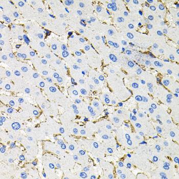 SSTR2 Antibody - Immunohistochemistry of paraffin-embedded Human liver damage using SSTR2 Polyclonal Antibody at dilution of 1:100 (40x lens).