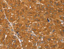 SSTR3 Antibody - Immunohistochemistry of paraffin-embedded Human liver cancer using SSTR3 Polyclonal Antibody at dilution of 1:30.