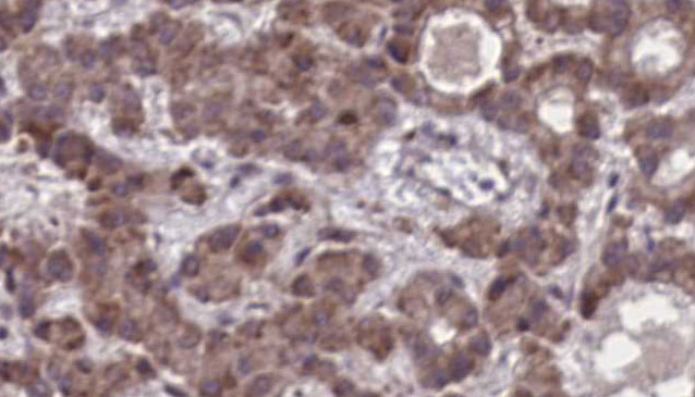 SSTR3 Antibody - 1:100 staining human liver carcinoma tissues by IHC-P. The sample was formaldehyde fixed and a heat mediated antigen retrieval step in citrate buffer was performed. The sample was then blocked and incubated with the antibody for 1.5 hours at 22°C. An HRP conjugated goat anti-rabbit antibody was used as the secondary.