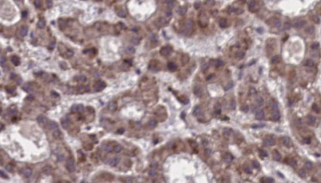 SSTR5 Antibody - 1:100 staining human liver carcinoma tissues by IHC-P. The sample was formaldehyde fixed and a heat mediated antigen retrieval step in citrate buffer was performed. The sample was then blocked and incubated with the antibody for 1.5 hours at 22°C. An HRP conjugated goat anti-rabbit antibody was used as the secondary.